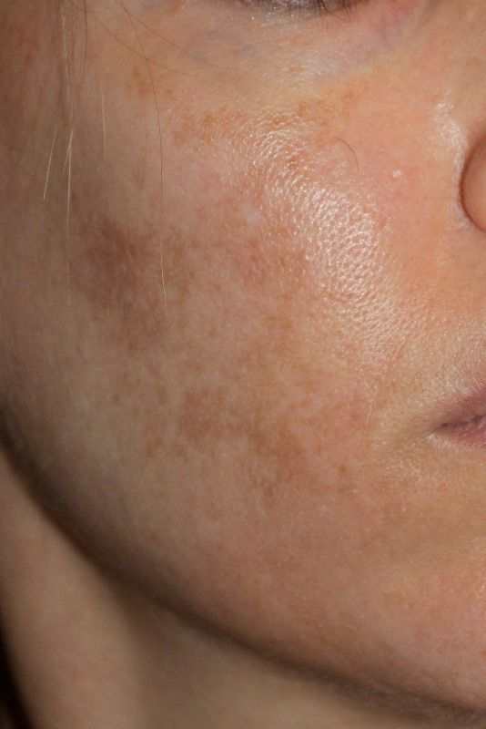 Dull Skin